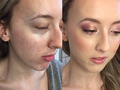 How to achieve a Natural looking foundation when you have acne?