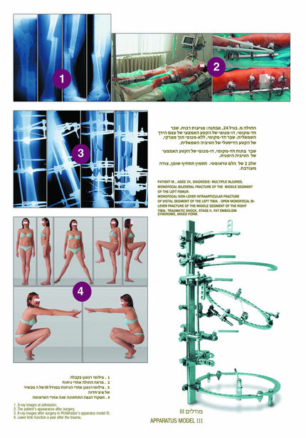 Ex Fix by Pichkhadze