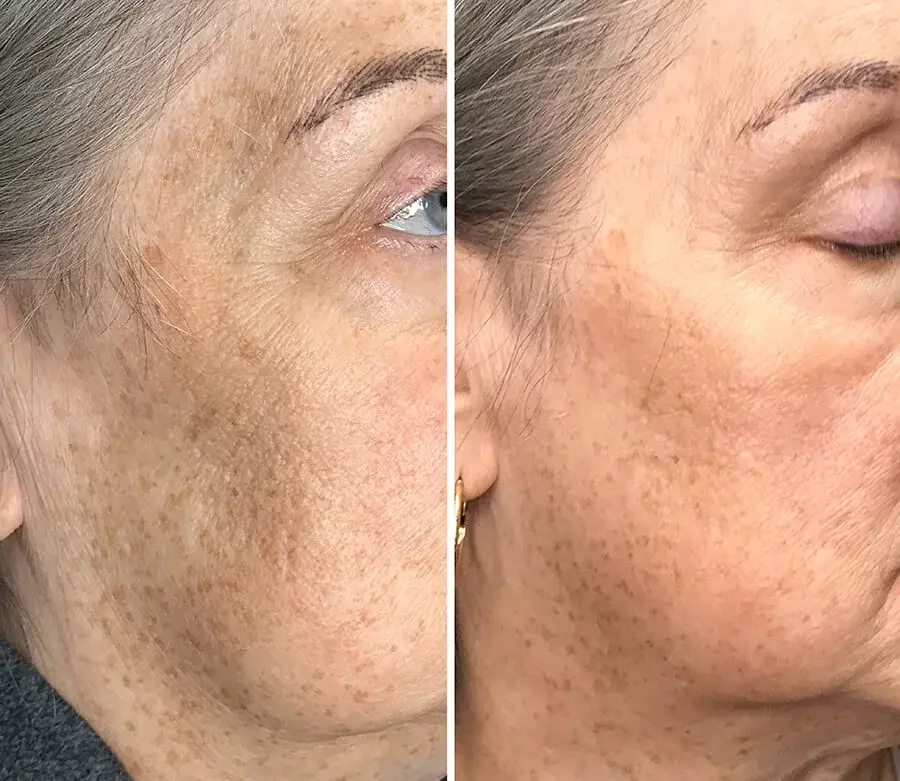 Plasma Pen Treatment