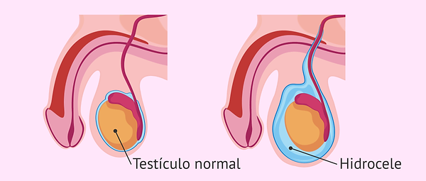 hidrocele.png