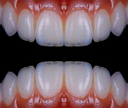 Restauraciones dentales completas