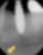 Example of early delamination artifact in scintillating x-ray sensor.