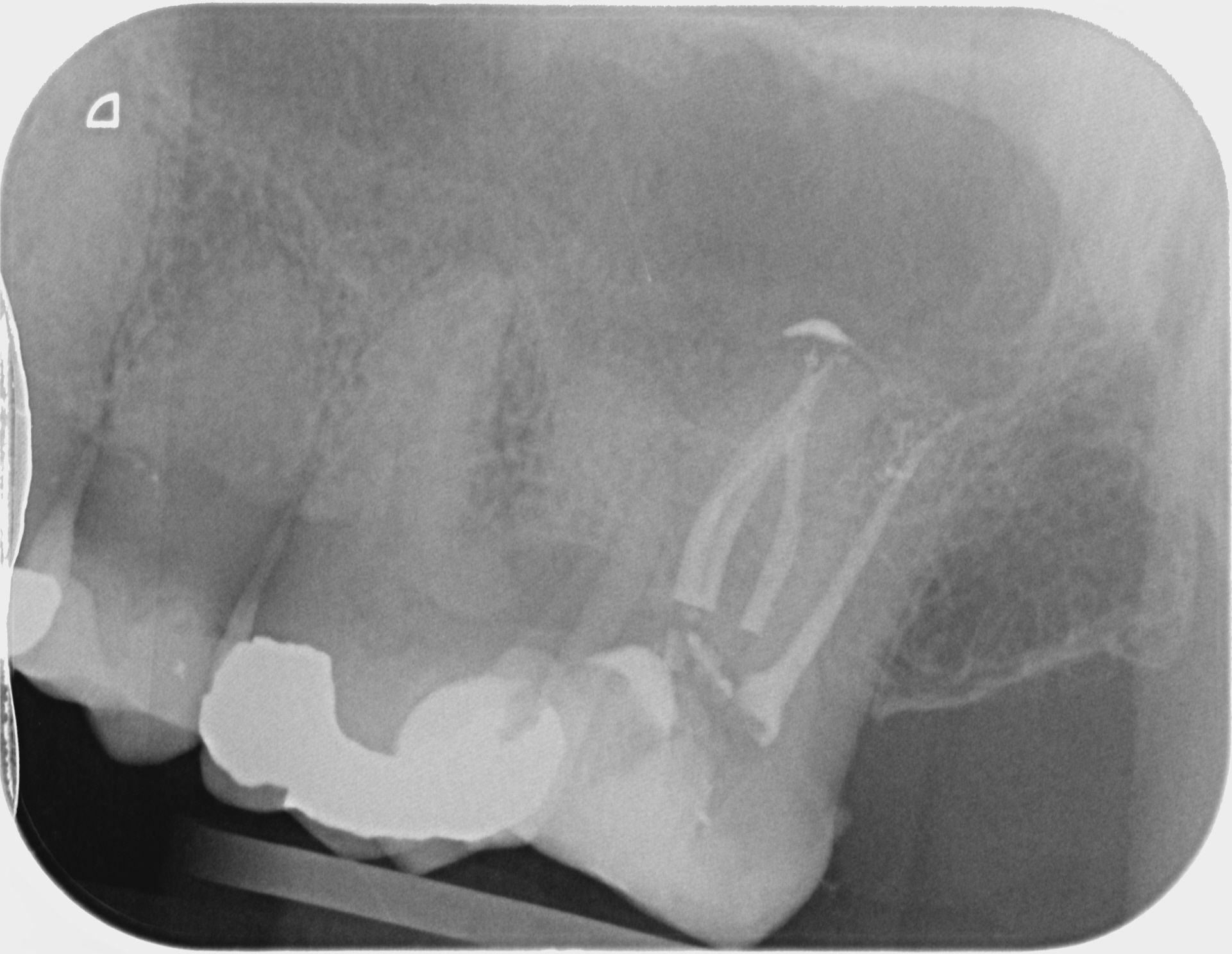 Dévitalisation molaire