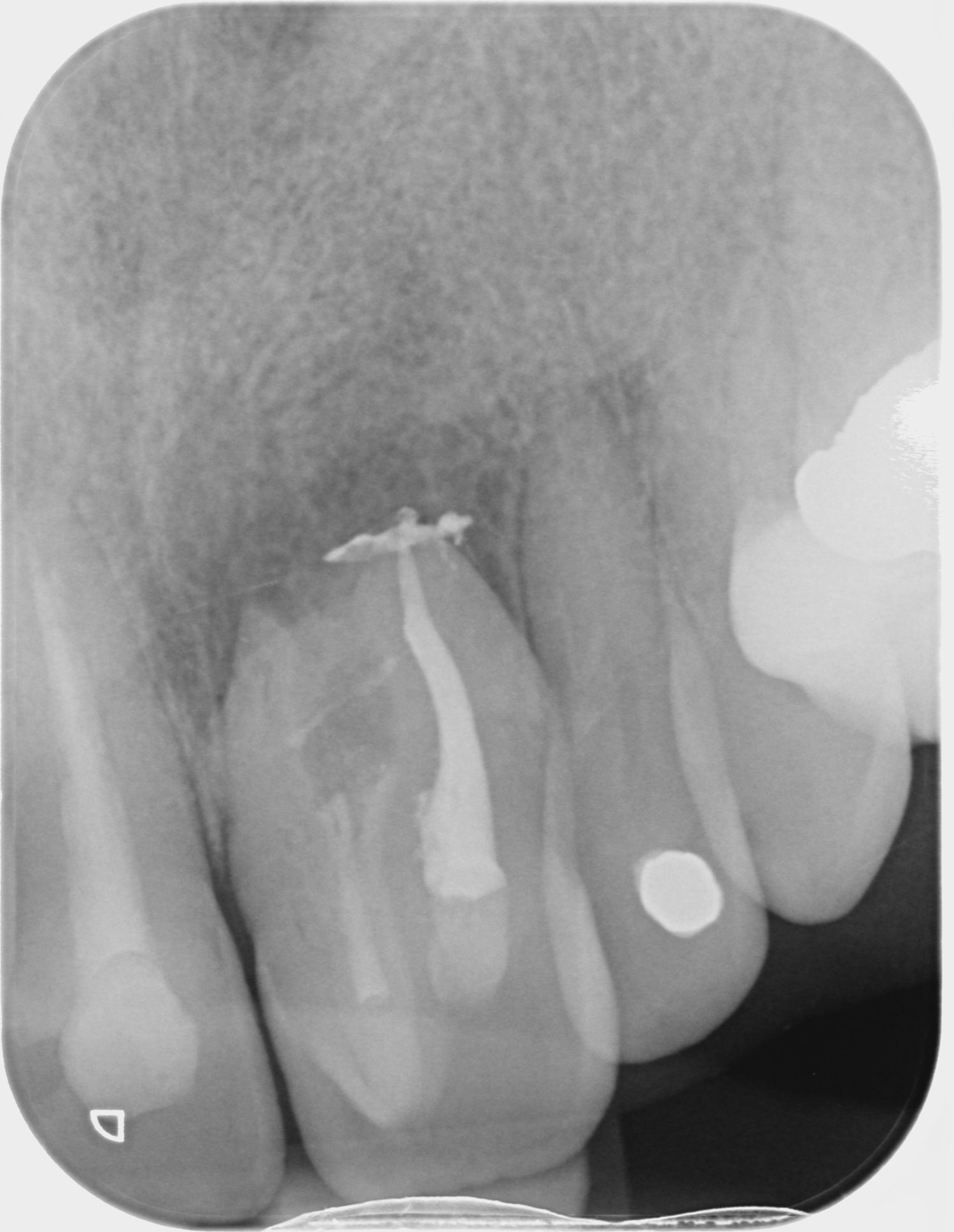 Dens in dente