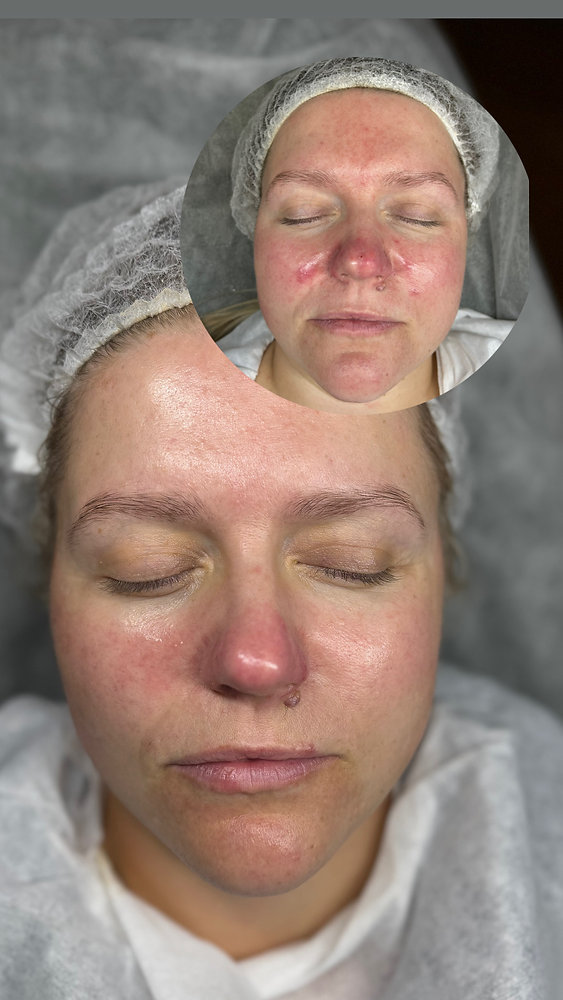 Viimastel kuudel on Medicina kliinikus käinud mitmed sotsiaalmeedia mõjuisikud, kes soovisid leevendada püsivat punetust ja tundlikku nahka. Nende kogemused oli