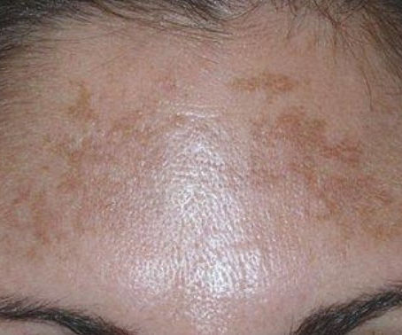MELASMA (hüperpigmentatsioon)