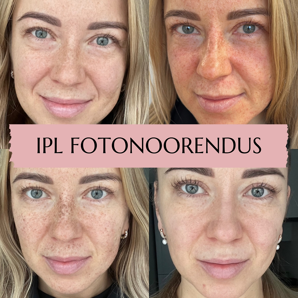 Thumbnail: IPL FOTONOORENDUS ja PIGMENDIRAVI näonahale