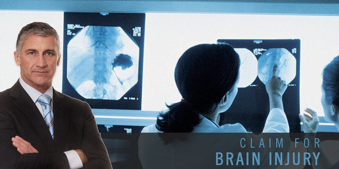 Raise Your Brain Injury Claims in UK - Seriously Injured