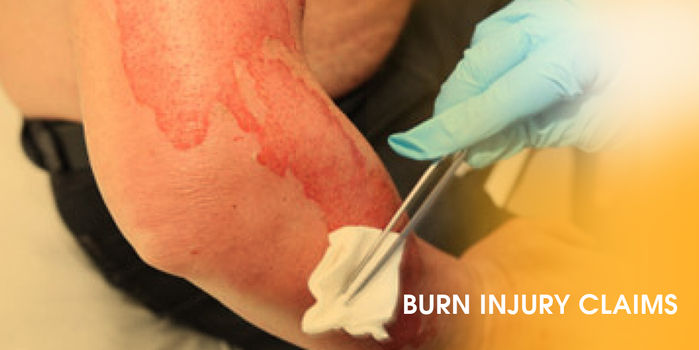 Types of Burn Injury and Claims - Seriously Injured