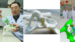 Médicos chinos trasplantan con éxito una cadera gracias a la impresión 3D