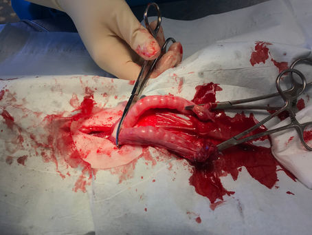 A Thick Uterus and a Ruptured Tumor
