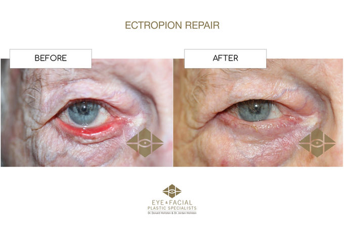 Ectropion Repair - Case  2-1 - DAH.jpg