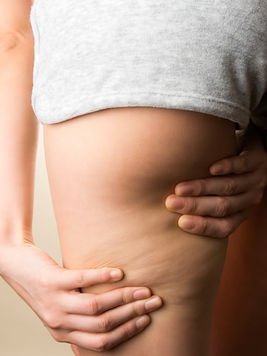 La cellulite aumenta con l’età, ma perché?