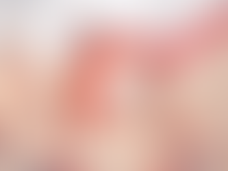 Illustration anatomique montrant une dent de sagesse incluse dans la mâchoire inférieure, responsable d’une inflammation gingivale et d’une compression sur la dent adjacente, situation fréquente nécessitant une extraction.