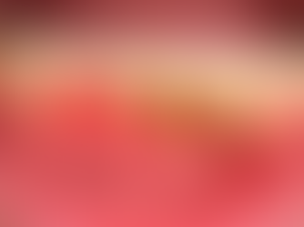 Gingivite et parodontite : gencives inflammées, rouges et saignantes avec accumulation de plaque et de tartre au niveau du collet dentaire.