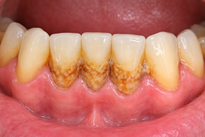 ניקוי אבנית בשיניים: מתי צריך, למה הוא חשוב וכיצד מתבצע הטיפול