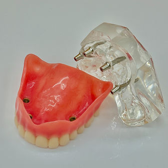 Removable Implant Dentures