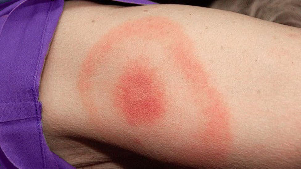 Tick Bite Bullseye from Lyme Disease
