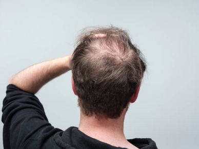 【逆轉髮旋禿】專業活髮攻略:數據證明ProHair寶康助你重拾濃密秀髮!