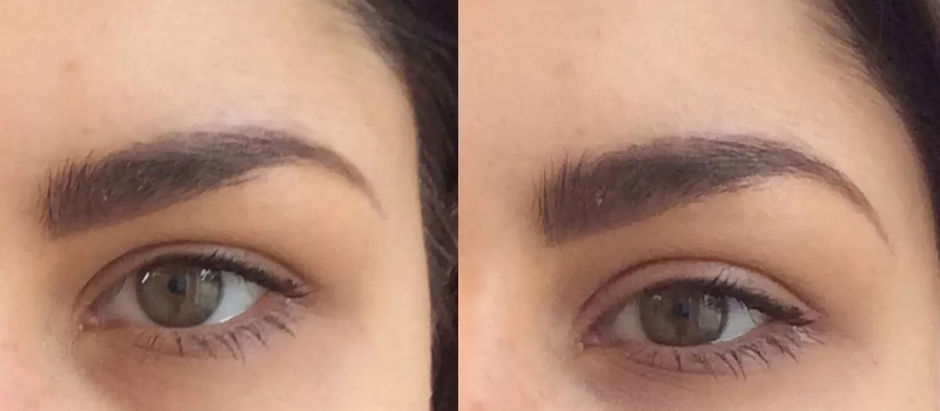 Reviving the Sparkle: How Fillers Redefine Aging Gracefully in the Tear Trough and Midface Area