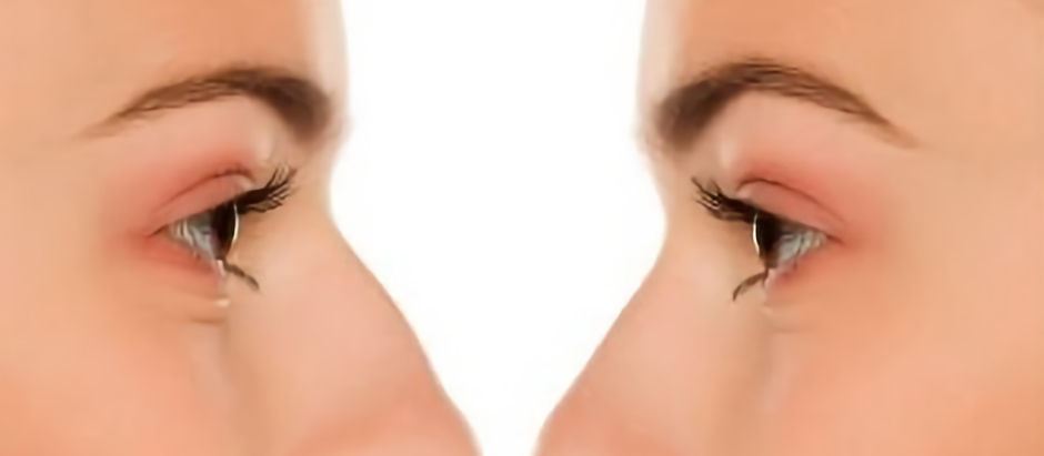 The Evolution of Dermal Fillers: Exploring Innovative Uses in Cosmetics and Non-Surgical Rhinoplasty