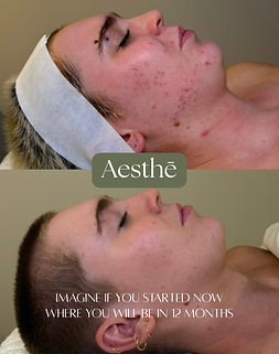 ACNE before and afters.png