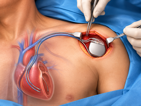 Why Is Pacemaker Surgery the Right Solution for Treating Slow Heart Rhythms?