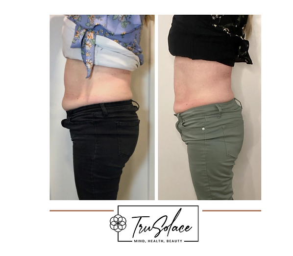 Before & After TruSolace Healing