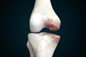 Knee Osteoarthritis_img.jpg