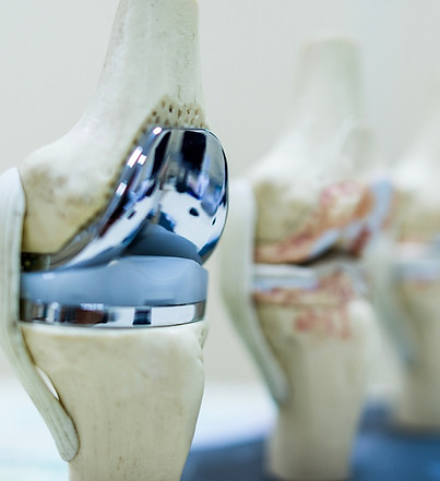 Knee Replacement_img.jpg