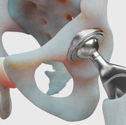 Hip Replacement_img.jpg