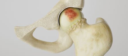 arthritis_img.jpg
