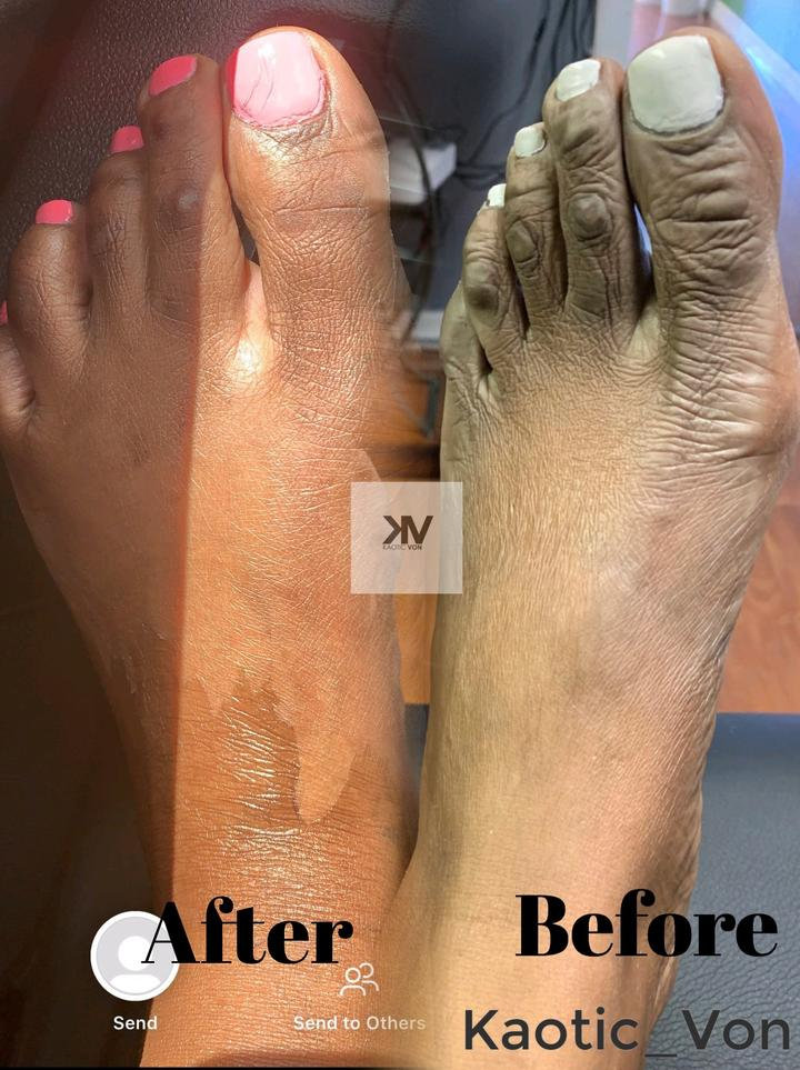 Corn Blast Remover Kaoticvon Packaging:2pcs × foot care tool features: corn blast remover kaoticvon