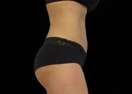 Emsculpt Neo After Picture