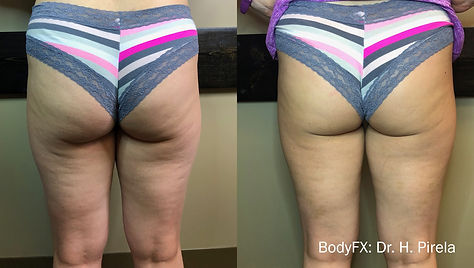 HP_BodyFx_1a_6tx-scaled.jpeg