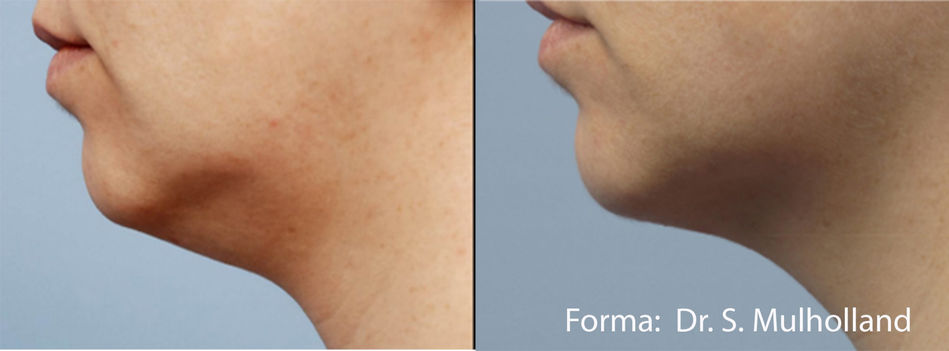 Forma neck and chin