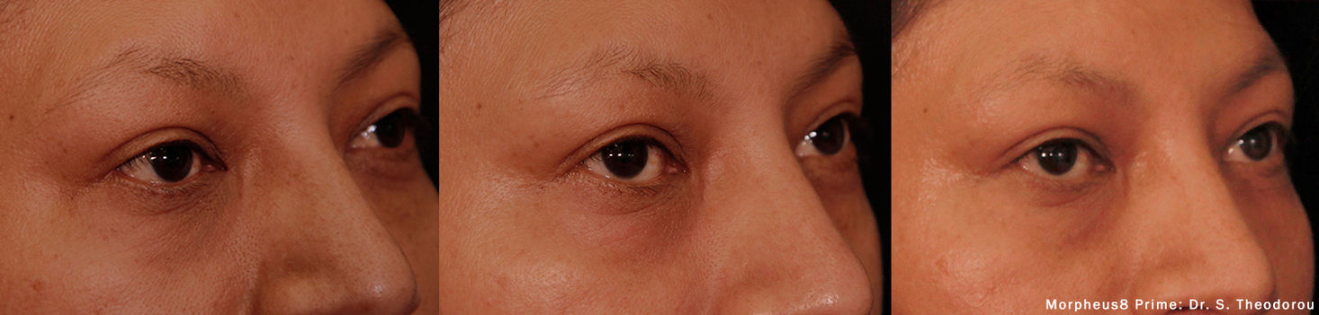 Morpheus8 Face