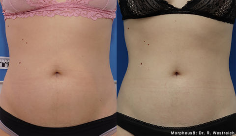 Morpheus8 -Abdomen