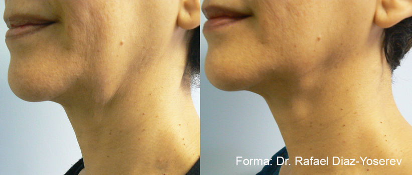 Forma 3 years results