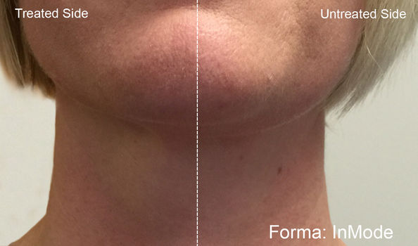 Forma before after