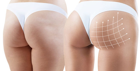 Emsculpt Neo - Buttocks