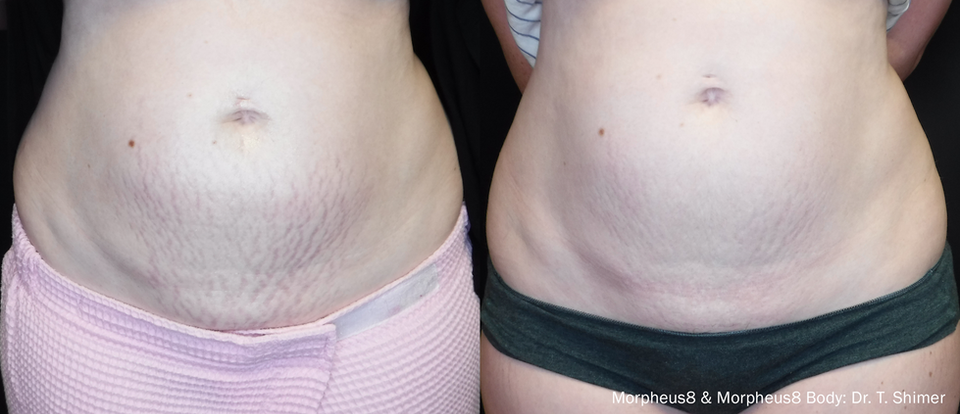 Morpheus8 Stretch Marks Abdomen