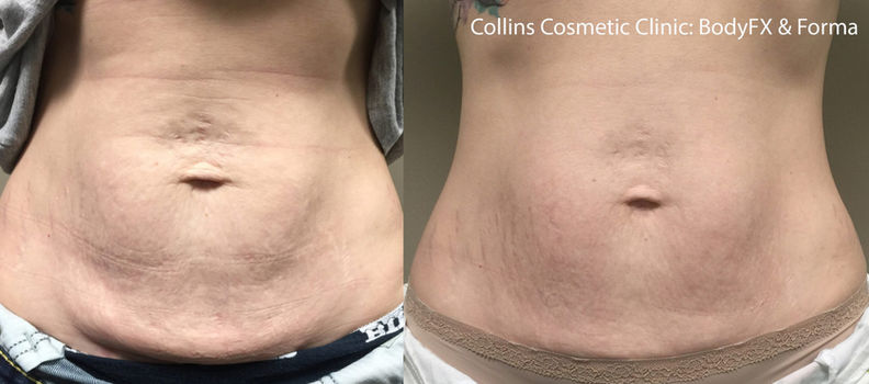 BodyFX Forma abdomen