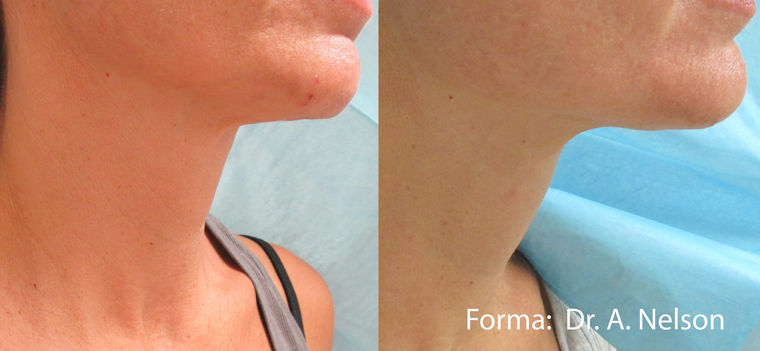 Forma neck results