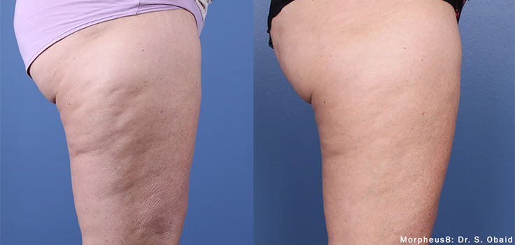 Morpheus8 cellulite