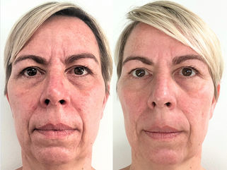 Charlottes forvandling med FaceFIT programmet.
