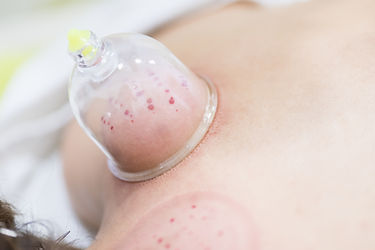Bloodletting (Hijama)