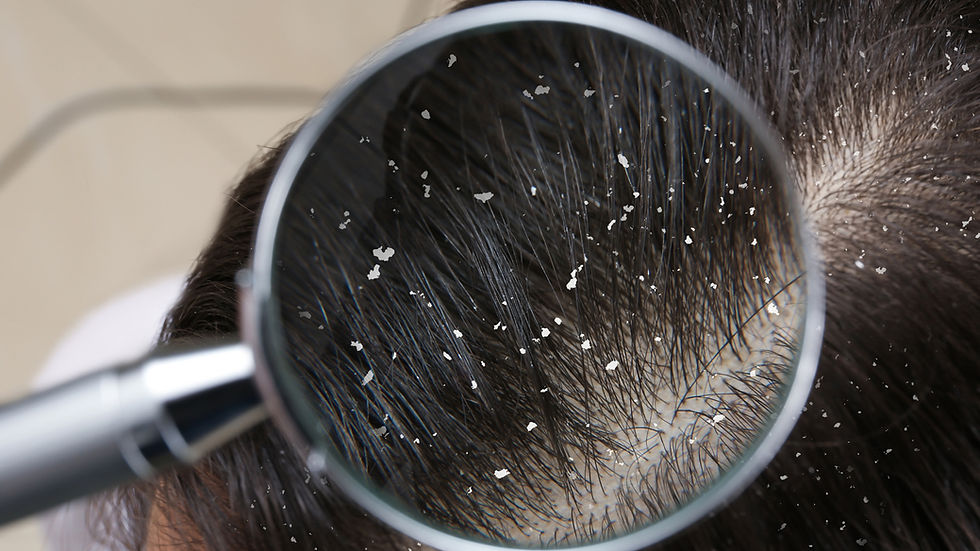 A magnifying glass focusing on a person’s scalp showing visible product buildup among dark hair strands.