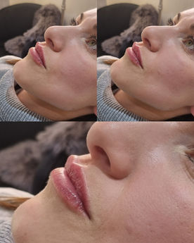 0.7ml lip filler