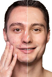 Kemisk peeling Mika Marin Sthlm: Puryvic Aknebehandling